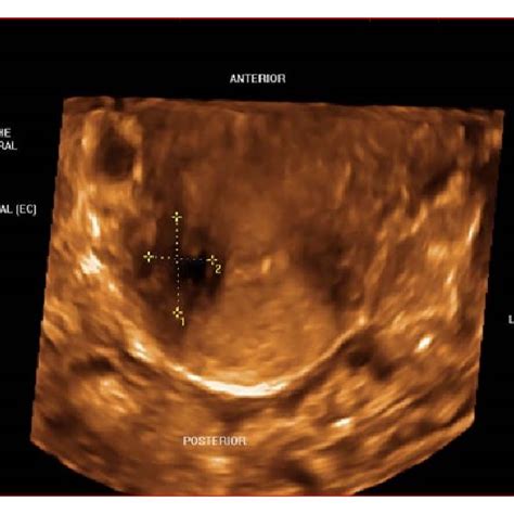 3dtvs rendering mode of the transverse view of the cervix demonstrating