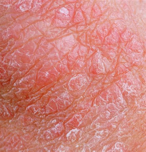 home remedies  cracked skin  pictures