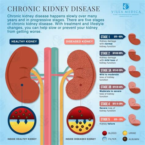 chronic kidney disease stage