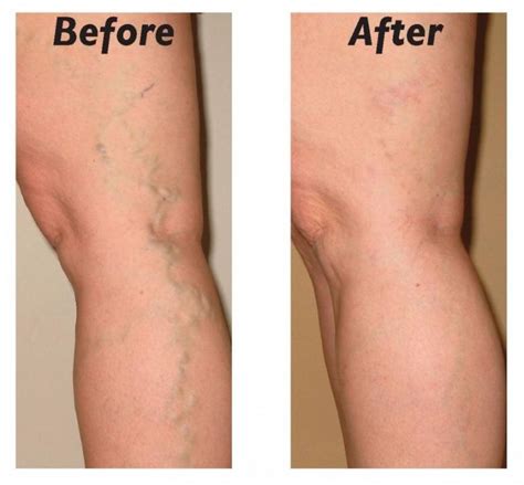 troubled  varicose veins   treated    easy