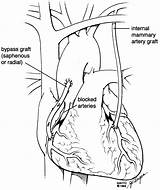 Bypass Coronary Artery Off Cabg sketch template