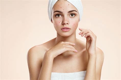 acne treatments   skin types