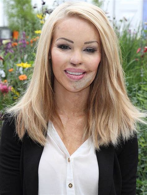 Katie Piper Opens Up About Her Struggle To Find Love After Acid Attack