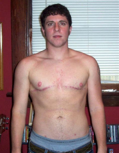 trans men and hysterectomy what to know ryansallans