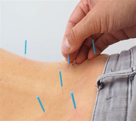 Akupunktur – Orthopäde Straubing