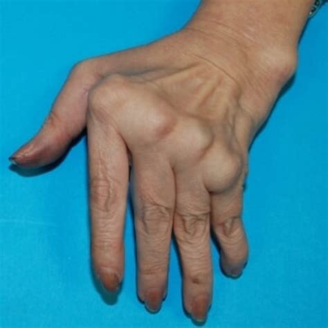 deformitas tangan hand surgery associates