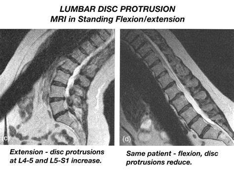 lumbar disc function flexion neurodynamic solutions