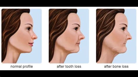 wisdom teeth removal change  face teeth poster