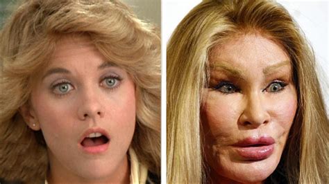 17 Hollywood Cases When Plastic Surgery Terribly Went