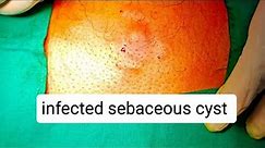 infected sebaceous cyst | incision and drainage | abscess | #dr #youtube