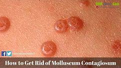 How to Get Rid of Molluscum Contagiosum