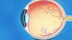 Laser Iridotomy for Glaucoma