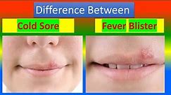 Difference between Cold Sore and Fever Blister