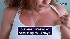 How Long You Can Expect a Sunburn to Last—and How To Treat It