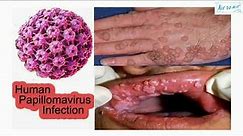squamous cell papilloma