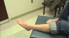 Results of Successful Foot Drop Surgery | Bloomington, Indiana Podiatrist