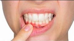 Ropień zębowy – co to jest i jak należy go leczyć? | Aktualności 360