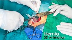 Hernia Repair (3D Animation) Surgical Procedure | Open And Laproscopic