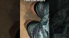 Osgood Shlatter update 1 year after surgery.