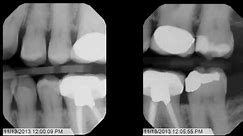 Tips and Tricks for Bitewing X-Rays