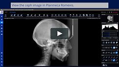 Planmeca scanning cephalostat: How to take a lateral ceph exposure