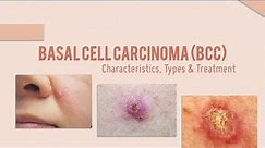 Basal Cell Carcinoma BCC Characterisitics, Types, Treatment options