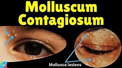 Molluscum Contagiosum (Water Warts) – Symptoms, Causes, Diagnosis, Treatment & Complications