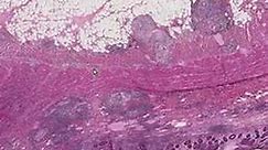 Histopathology Small intestine-- Crohn disease