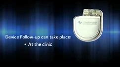 What is an Implantable Cardioverter Defibrillator (ICD)