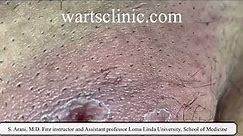 Molluscum self treatment causing deep skin infection and abscess
