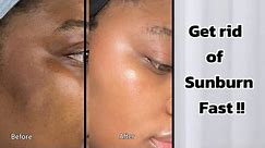 HOW TO CLEAR SUNBURN ON THE FACE FAST | SKINCARE PRODUCT FOR Hyperpigmentation, Melasma & Sunburn.