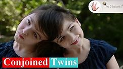 Conjoined Twins: Top 10 Facts You 🅳🅾🅽'🆃 Need to Know! ~ Body Bizarre!