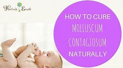 How To Cure Molluscum Contagiosum Naturally