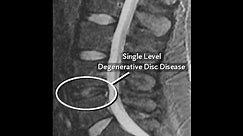 Video Explanation: What is Degenerative Disc Disease?