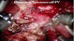 Robotowa pankreatoduodenektomia z cholecystektomią • Film • MEDtube.pl