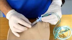 Needle Cricothyroidotomy