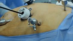 Kiev Ukraine 19 April 2024: Laparoscopic cholecystectomy instrument. The surgeon's doing laparoscopic gastric sleeve surgery in the operating room. Close-up