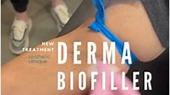 Derma BioFiller - The Aesthetic Clinique