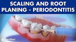Treatment of periodontal disease - Scaling and root planing - Tartar ©