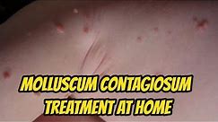 Molluscum contagiosum Treatment At Home