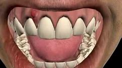 Was ist ein Zahnherd - Zahn Abszess