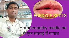 FORDYCE SPOTS cause symptoms and homoeopathic remedies