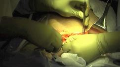 Basic Primary Cesarean Delivery Video