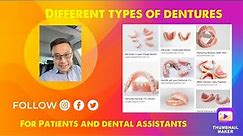 Flipper, Stayplate, Partial denture, Complete denture and implant Over-denture