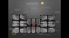 The Full Mouth X-ray Survey Identification & Film Mounting