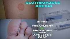 Clotrimazole cream: An Effective Antifungal Cream for Ring worm | Treatment and Usage