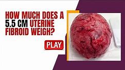 How Much does a 5.5 CM Uterine Fibroid Weigh? [Learn More]