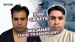 3100 Grafts Before and After Transformation: Remarkable 1-Year Results Unveiled!