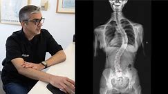 Severe Scoliosis Evaluation & Treatment @DrRahim Chiropractic