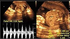 PREGNANCY PROFILE (2ND Trimester ) | Ultrasound Pregnancy Profile